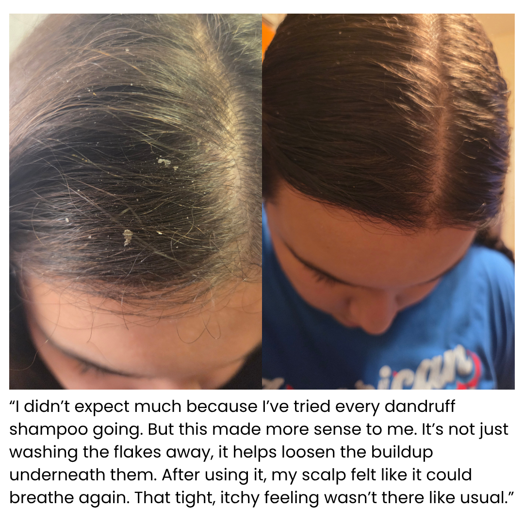 Scalp Microbiome Solution for Flakes, Itch & Oily Scalp