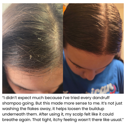 Scalp Microbiome Solution for Flakes, Itch & Oily Scalp