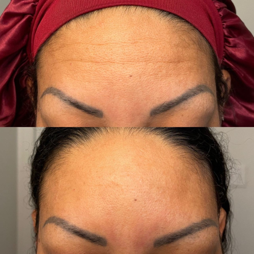 Bare™ Serum Sealing Forehead Tape